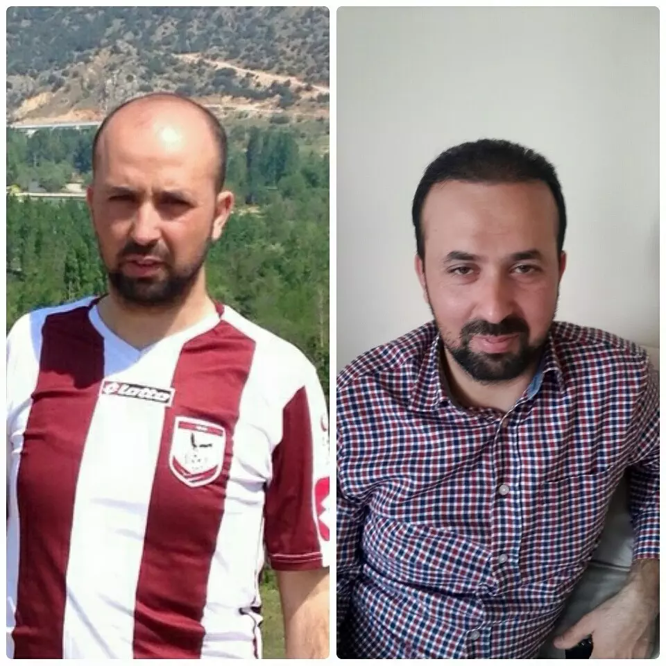 Hair Transplant Before After 8