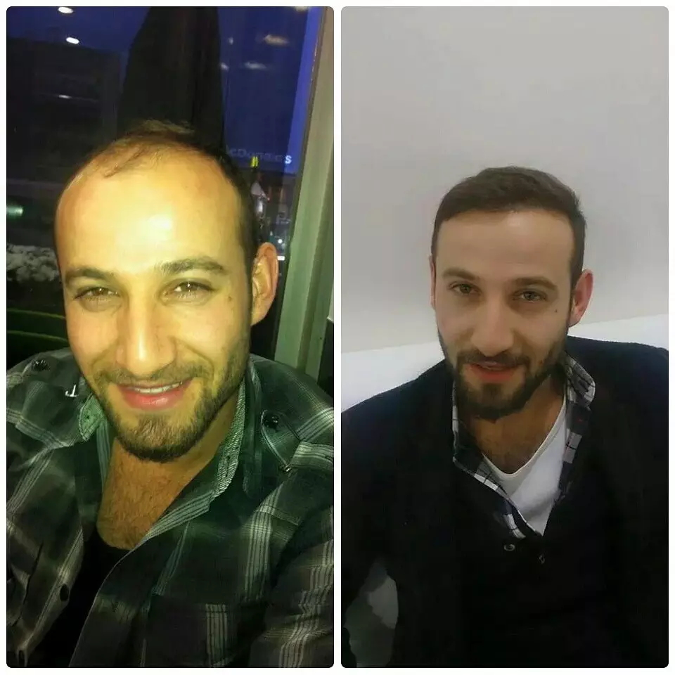 Hair Transplant Before After  6