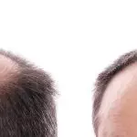 How Much Does 5000 Graft Hair Transplant Cost in Turkey?