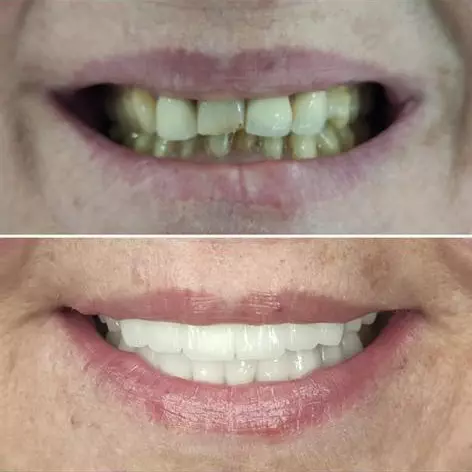 Hollywood Smile Cost in Istanbul, Turkey- Smile Makeover Turkey