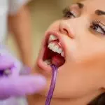Izmir Dental Veneers Prices- Dental Clinics