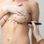 Low-Cost Breast Lift in Istanbul, Turkey: Procedure and Packages