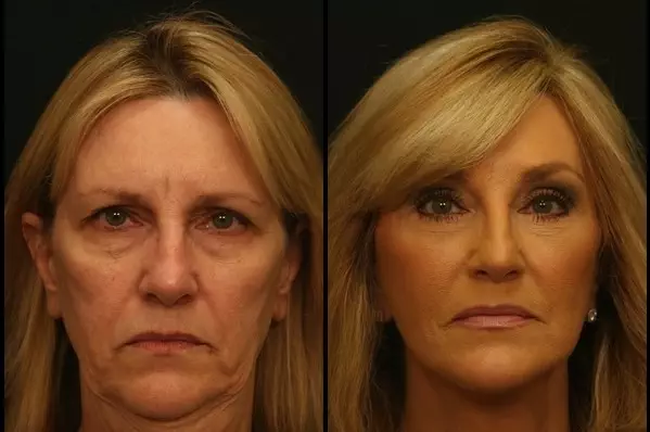 Face Lift Before - After 4