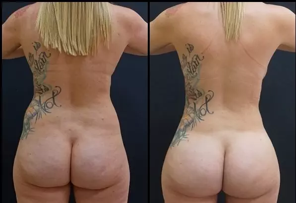 Brazilian Butt Lift Before - After 2