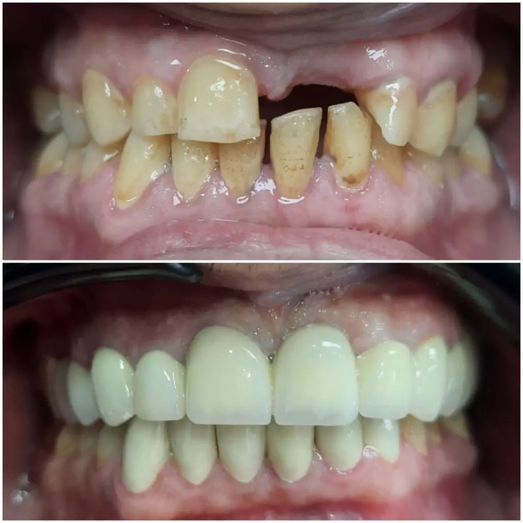 Dental Implant Before - After 2