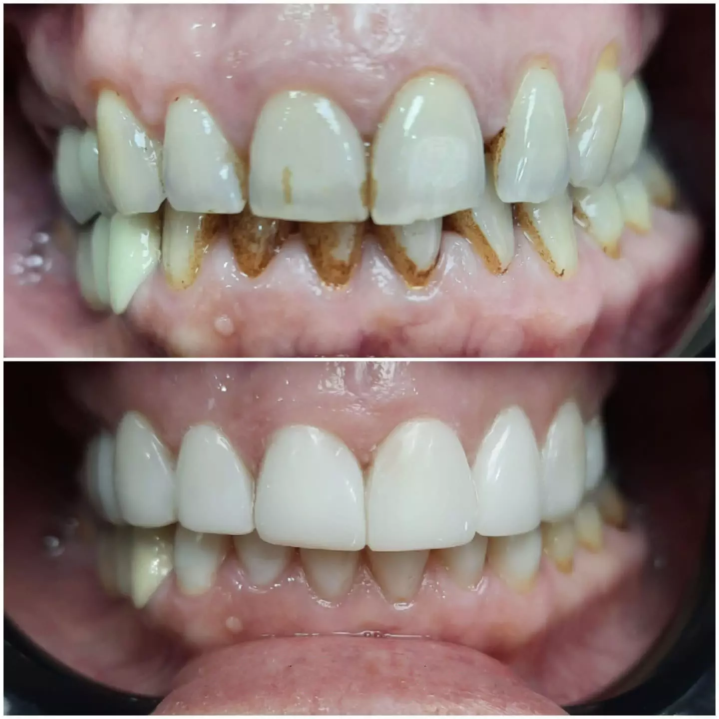 Белење на заби пред - после 2
