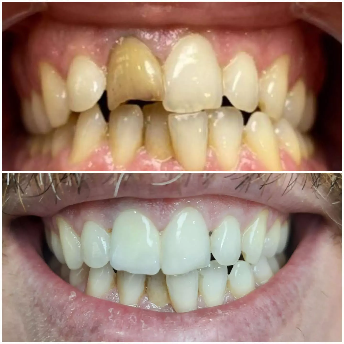 Белење на заби пред - после 3
