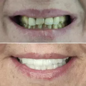 Hollywood Smile Before - After 2