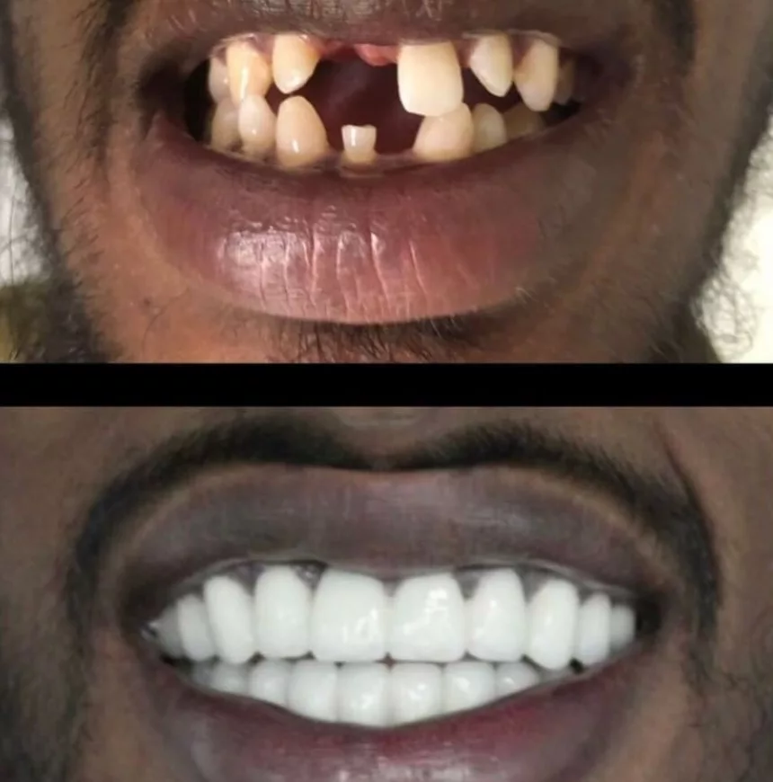 Dental Implant Before - After 1