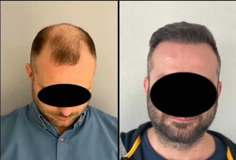Hair Transplant Before After  1