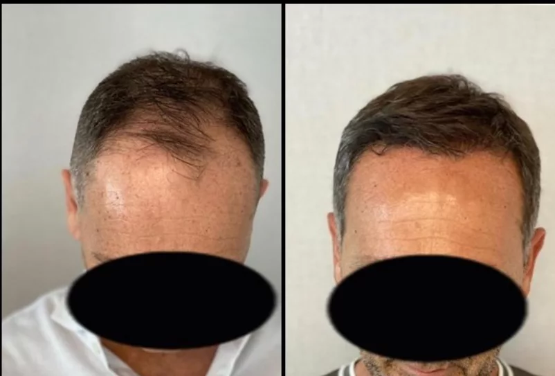 Hair Transplant Before After  2