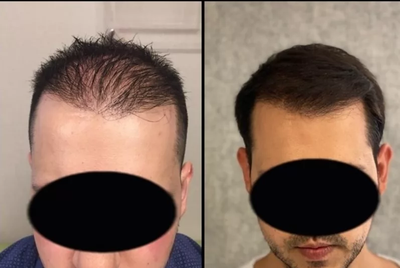 Hair Transplant Before After  4