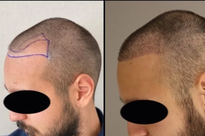 Hair Transplant Before After  5