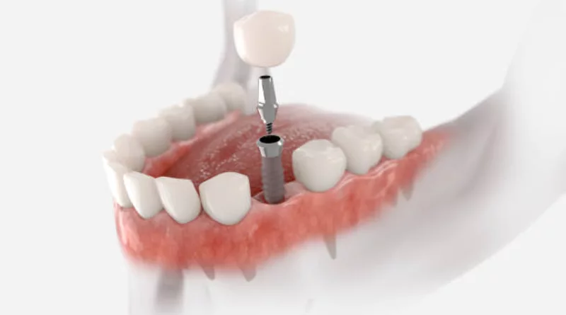 dental implants in montenegro