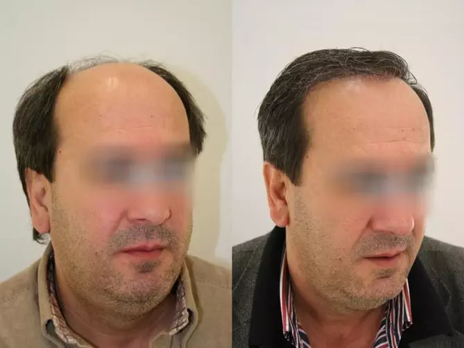 hair transplants in turkey before and after photos