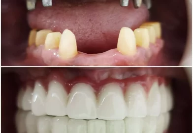Dental Implant Qaib ntxhw vs Albania vs Sirbia, quailty, nqi thiab lwm yam.